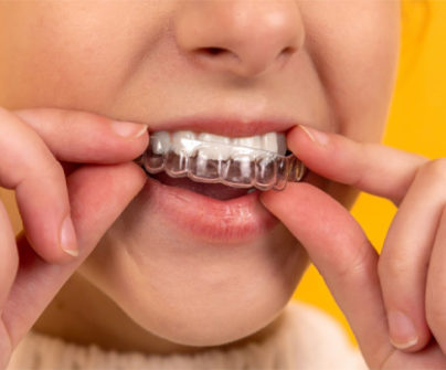 Invisalign – Clear aligners Therapy