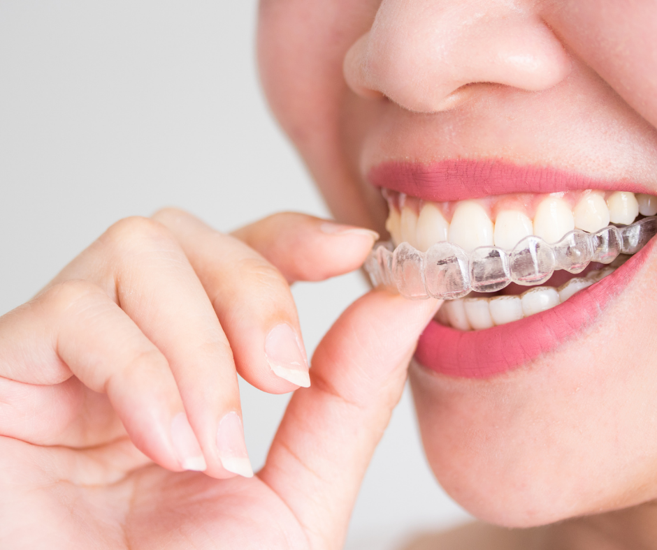 Invisalign is removable and this is a benefit of invisalign. Get yours today at Broadway Smiles Vancouver Dentist in Kitsilano.