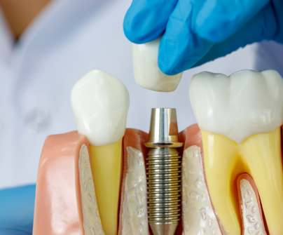 get dental implants in vancouver. dental implants performed in kitsilano at broadway smiles by dr.dhia mahmud