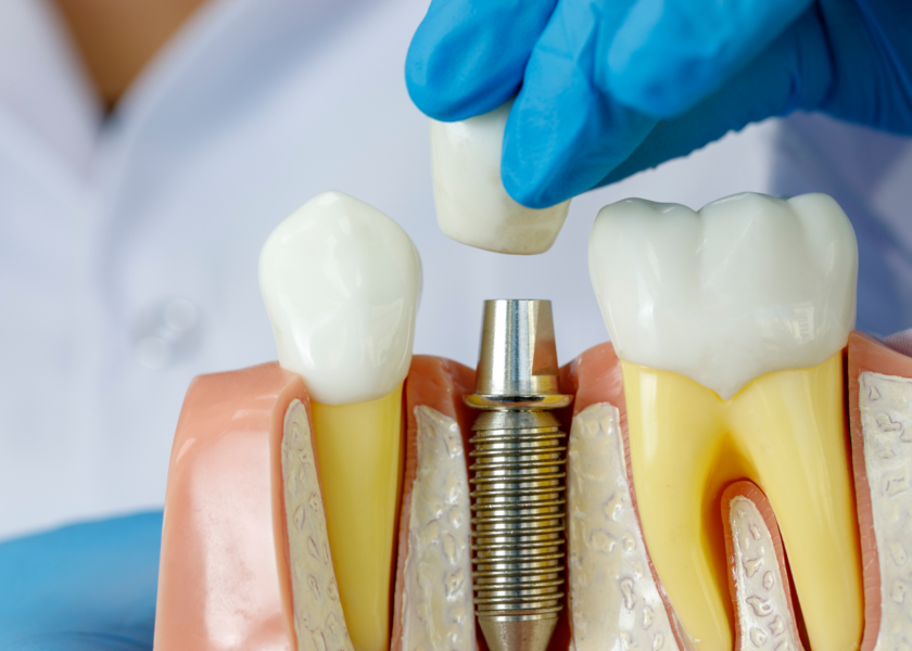 get dental implants in vancouver. dental implants performed in kitsilano at broadway smiles by dr.dhia mahmud