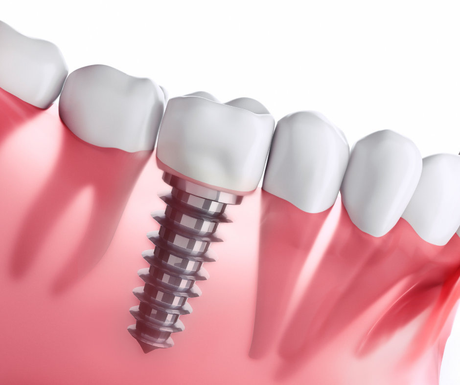 dental implants in vancouver. Get them done at broadway smiles with dr.dhia mahmud today. dental implants in kitsilano.