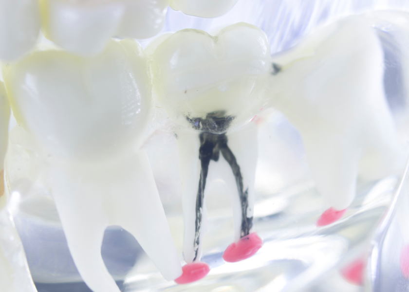 why you might need a root canal in vancouver.