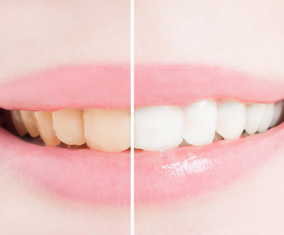 diy teeth whitening solutions in vancouver