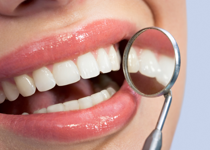 Benefits of Getting a Dental Polish